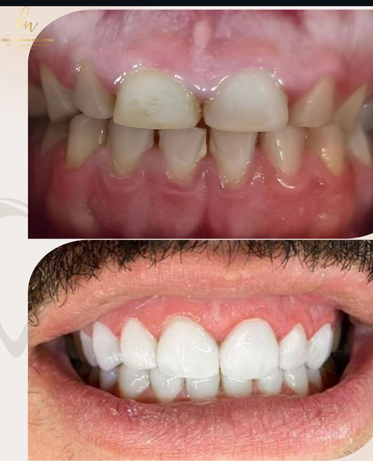 Caso de Resina Avançada Barreiras